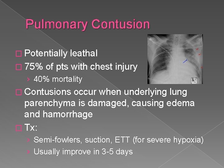 Pulmonary Contusion � Potentially leathal � 75% of pts with chest injury › 40%
