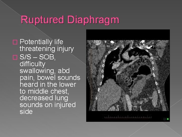 Ruptured Diaphragm Potentially life threatening injury � S/S – SOB, difficulty swallowing, abd pain,