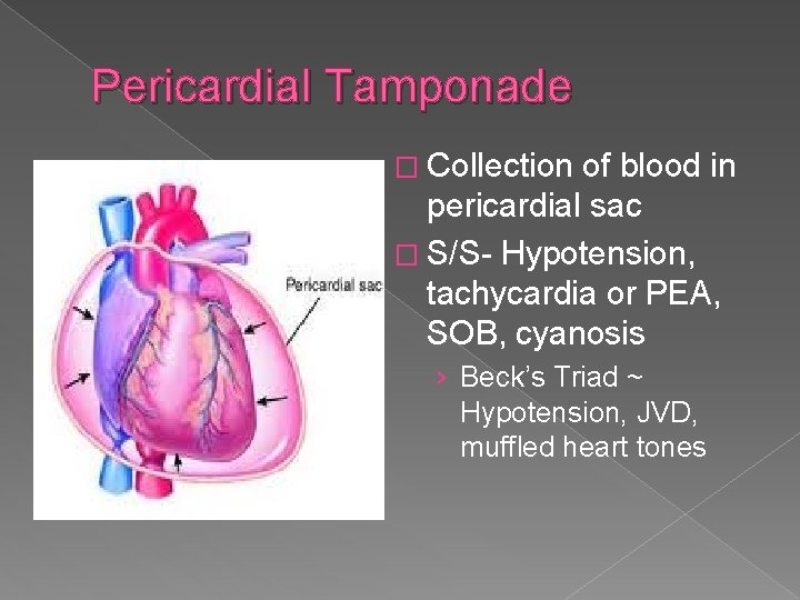 Pericardial Tamponade � Collection of blood in pericardial sac � S/S- Hypotension, tachycardia or