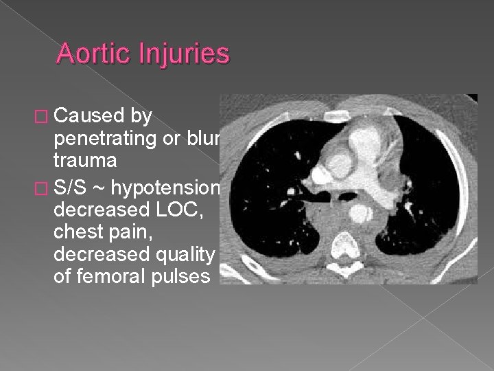 Aortic Injuries � Caused by penetrating or blunt trauma � S/S ~ hypotension, decreased