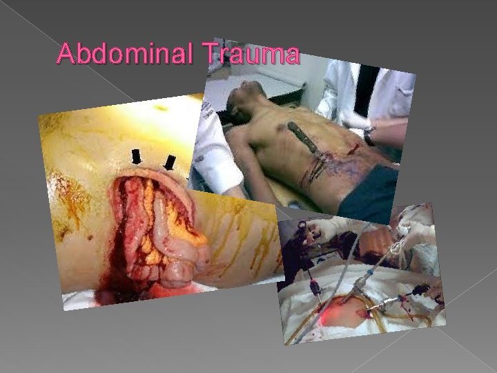 Abdominal Trauma 