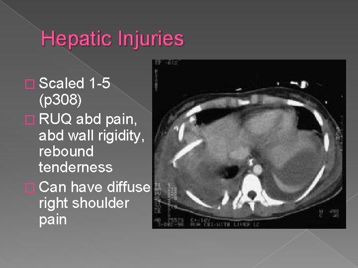 Hepatic Injuries � Scaled 1 -5 (p 308) � RUQ abd pain, abd wall