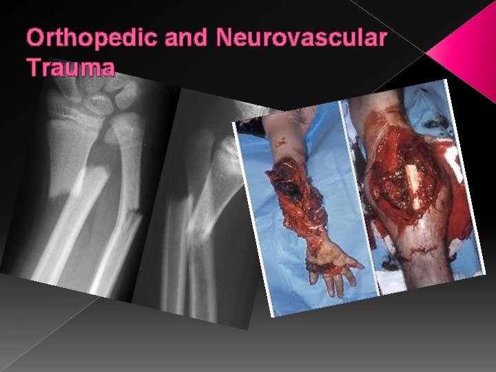 Orthopedic and Neurovascular Trauma 