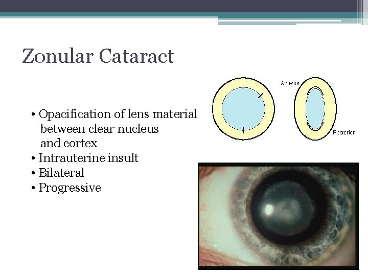 Zonular Cataract • Opacification of lens material between clear nucleus and cortex • Intrauterine