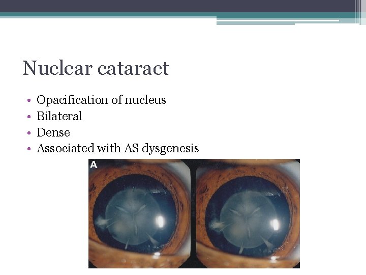 Nuclear cataract • • Opacification of nucleus Bilateral Dense Associated with AS dysgenesis 