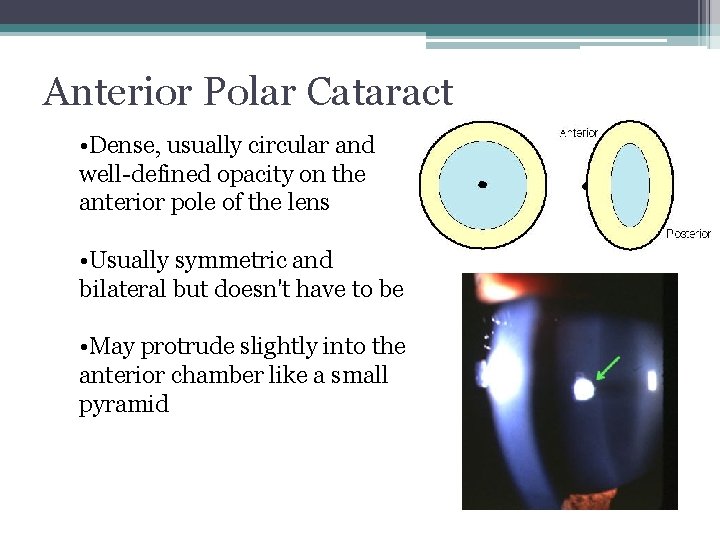 Anterior Polar Cataract • Dense, usually circular and well-defined opacity on the anterior pole
