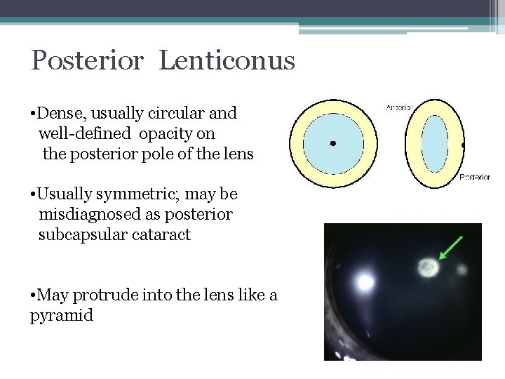 Posterior Lenticonus • Dense, usually circular and well-defined opacity on the posterior pole of