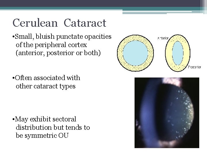 Cerulean Cataract • Small, bluish punctate opacities of the peripheral cortex (anterior, posterior or