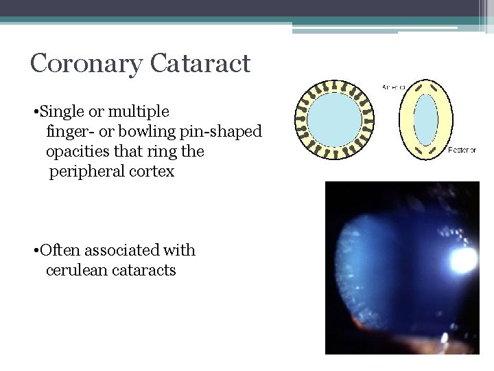 Coronary Cataract • Single or multiple finger- or bowling pin-shaped opacities that ring the