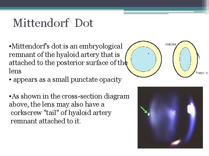 Mittendorf Dot • Mittendorf's dot is an embryological remnant of the hyaloid artery that