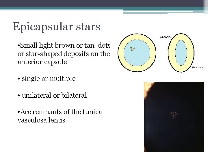 Epicapsular stars • Small light brown or tan dots or star-shaped deposits on the