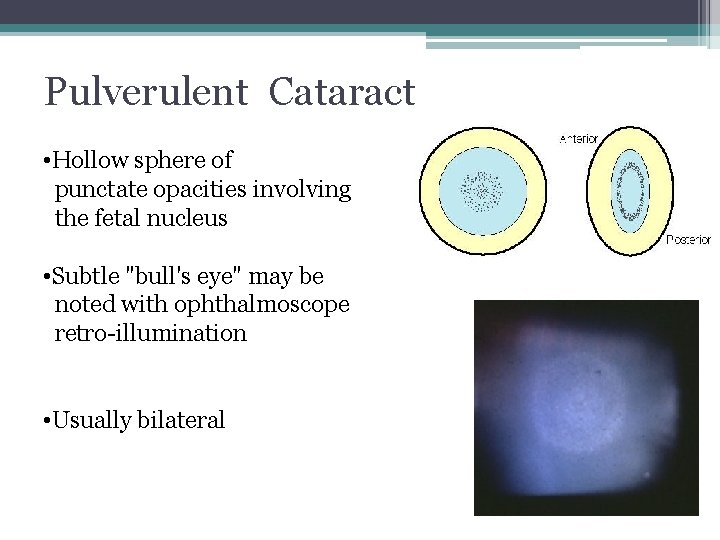 Pulverulent Cataract • Hollow sphere of punctate opacities involving the fetal nucleus • Subtle