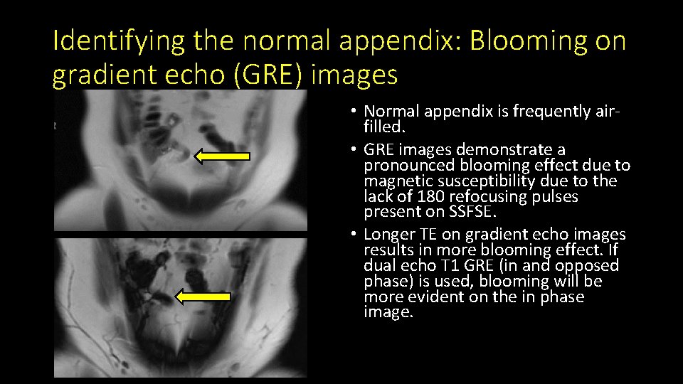 Identifying the normal appendix: Blooming on gradient echo (GRE) images • Normal appendix is