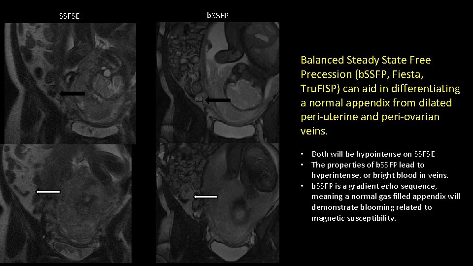 SSFSE b. SSFP Balanced Steady State Free Precession (b. SSFP, Fiesta, Tru. FISP) can