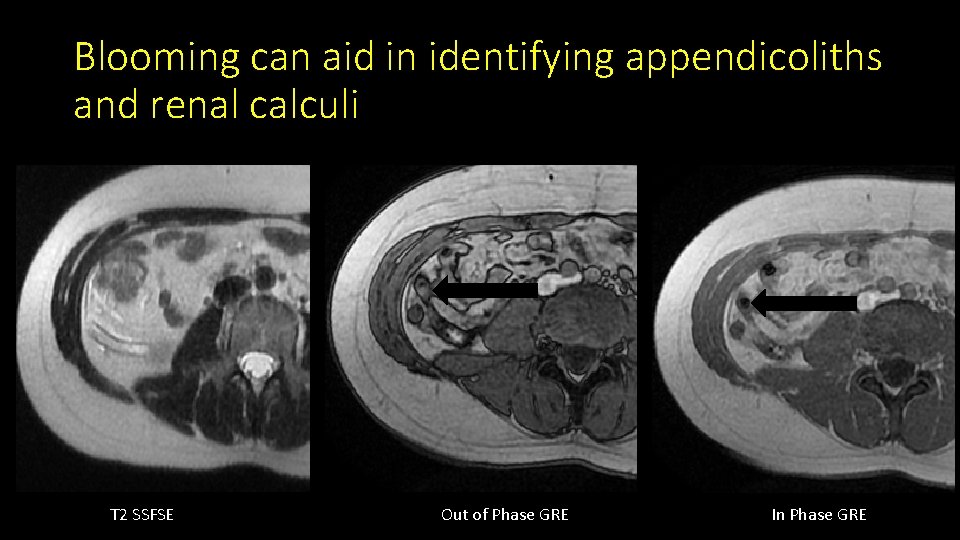 Blooming can aid in identifying appendicoliths and renal calculi T 2 SSFSE Out of