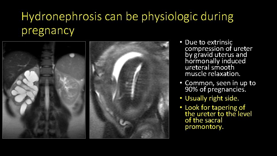 Hydronephrosis can be physiologic during pregnancy • Due to extrinsic compression of ureter by