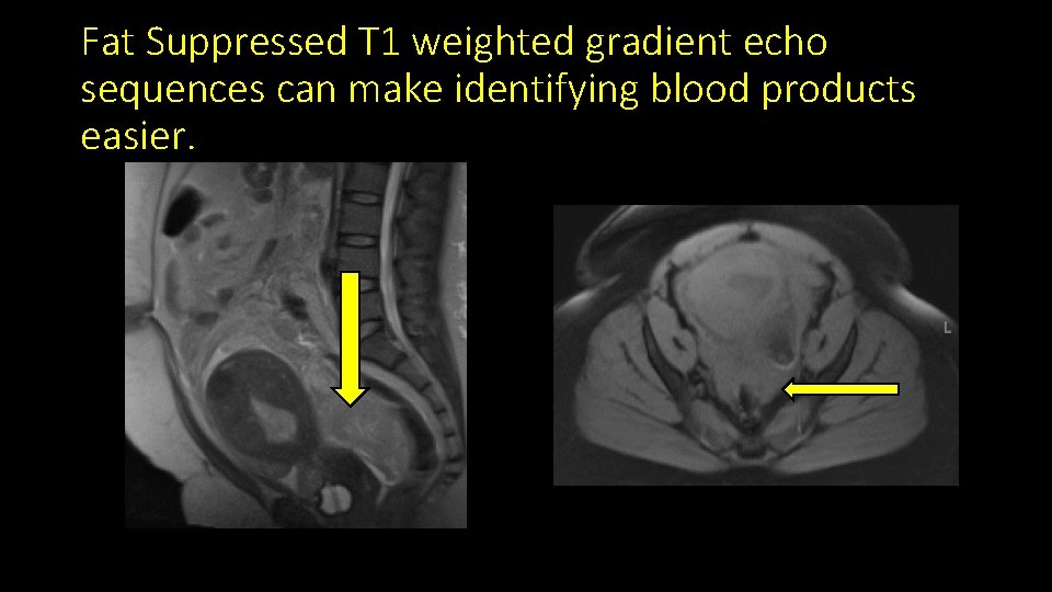 Fat Suppressed T 1 weighted gradient echo sequences can make identifying blood products easier.