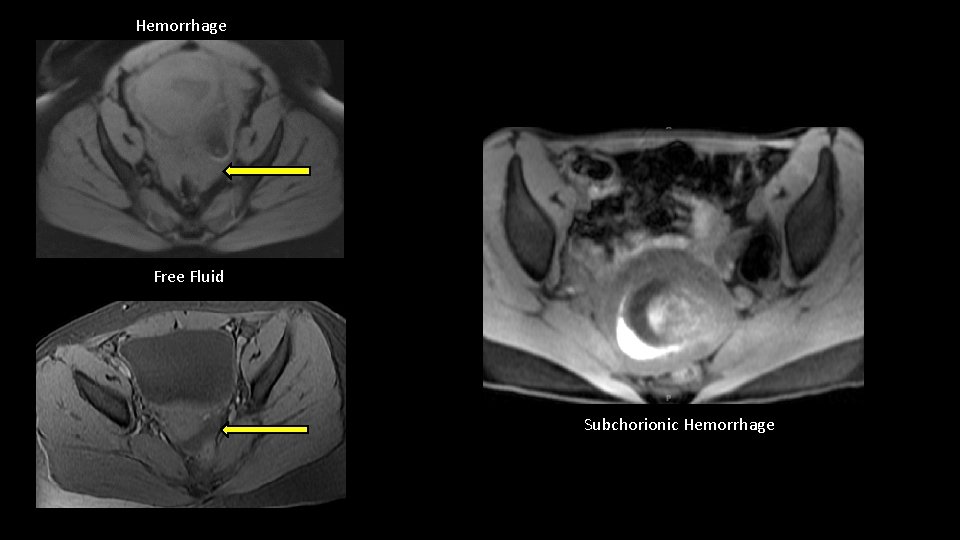 Hemorrhage Free Fluid Subchorionic Hemorrhage 