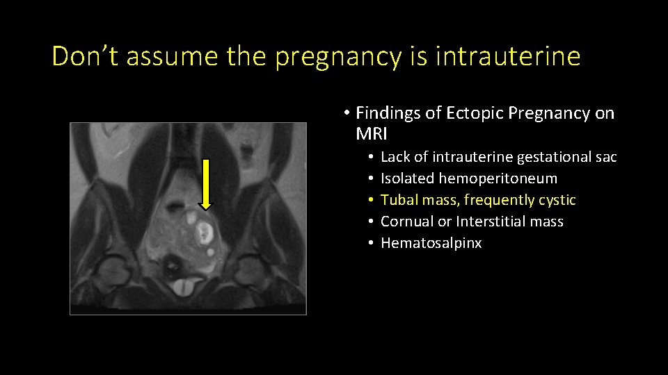 Don’t assume the pregnancy is intrauterine • Findings of Ectopic Pregnancy on MRI •