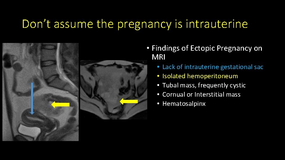 Don’t assume the pregnancy is intrauterine • Findings of Ectopic Pregnancy on MRI •