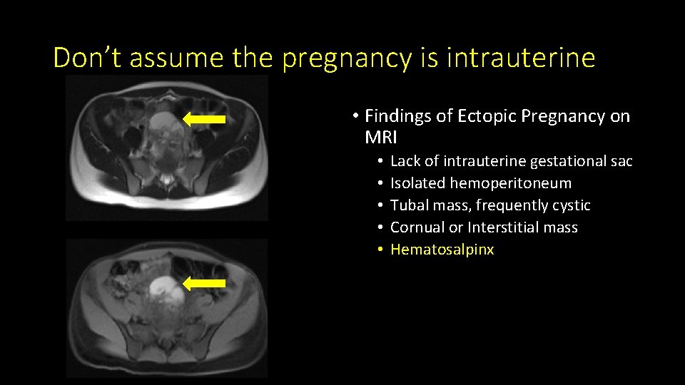 Don’t assume the pregnancy is intrauterine • Findings of Ectopic Pregnancy on MRI •