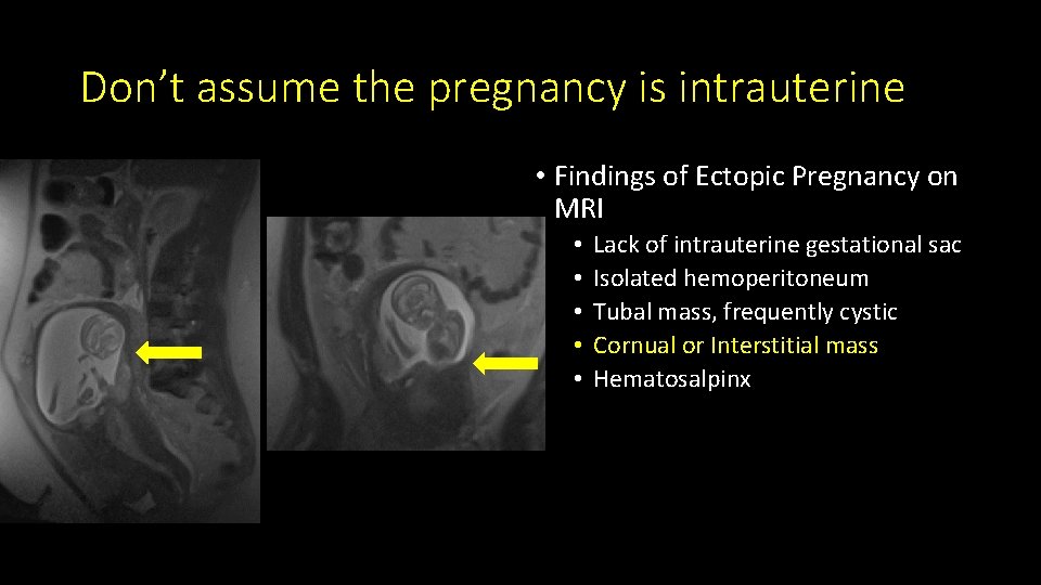Don’t assume the pregnancy is intrauterine • Findings of Ectopic Pregnancy on MRI •