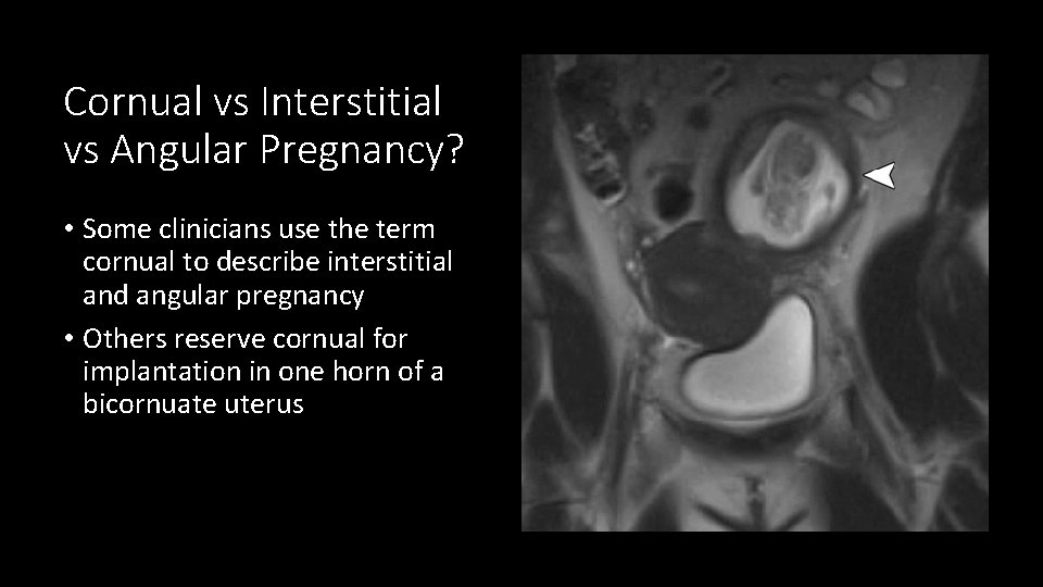 Cornual vs Interstitial vs Angular Pregnancy? • Some clinicians use the term cornual to