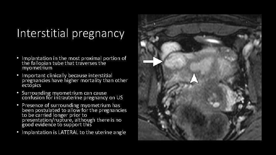 Interstitial pregnancy • Implantation in the most proximal portion of the fallopian tube that