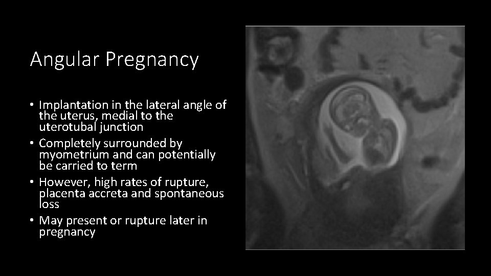 Angular Pregnancy • Implantation in the lateral angle of the uterus, medial to the