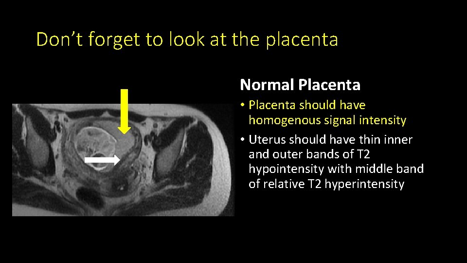 Don’t forget to look at the placenta Normal Placenta • Placenta should have homogenous