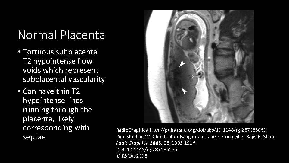 Normal Placenta • Tortuous subplacental T 2 hypointense flow voids which represent subplacental vascularity