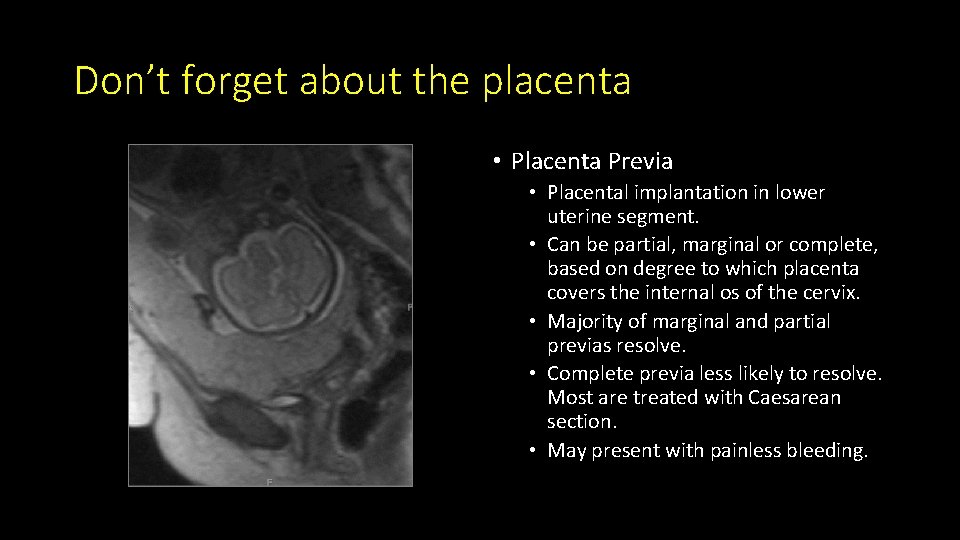 Don’t forget about the placenta • Placenta Previa • Placental implantation in lower uterine