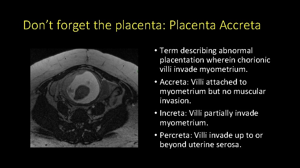Don’t forget the placenta: Placenta Accreta • Term describing abnormal placentation wherein chorionic villi