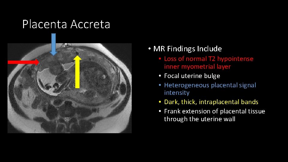 Placenta Accreta • MR Findings Include • Loss of normal T 2 hypointense inner