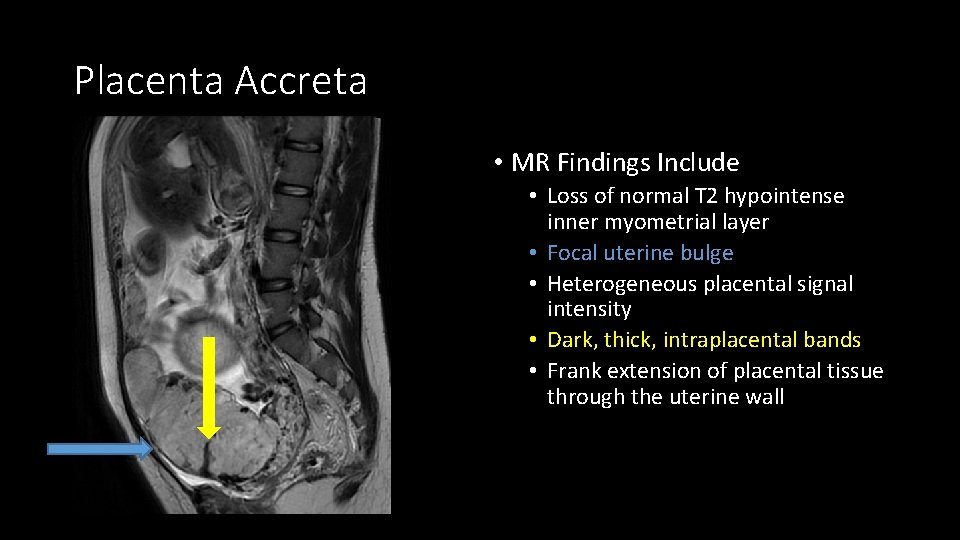 Placenta Accreta • MR Findings Include • Loss of normal T 2 hypointense inner