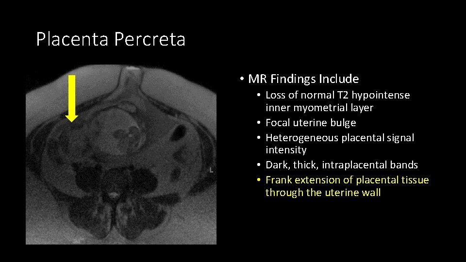 Placenta Percreta • MR Findings Include • Loss of normal T 2 hypointense inner
