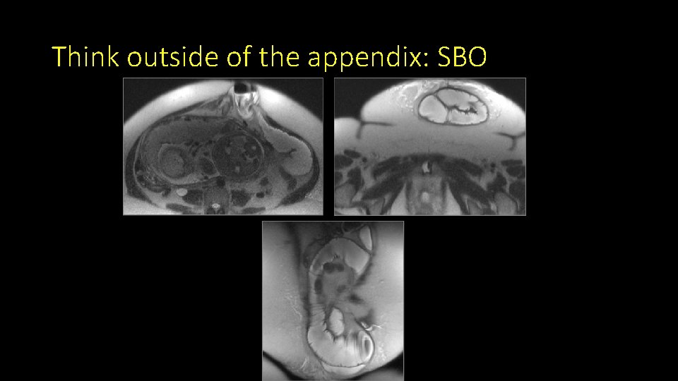 Think outside of the appendix: SBO 
