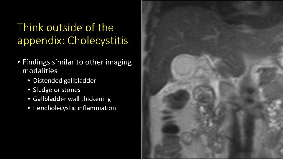Think outside of the appendix: Cholecystitis • Findings similar to other imaging modalities •