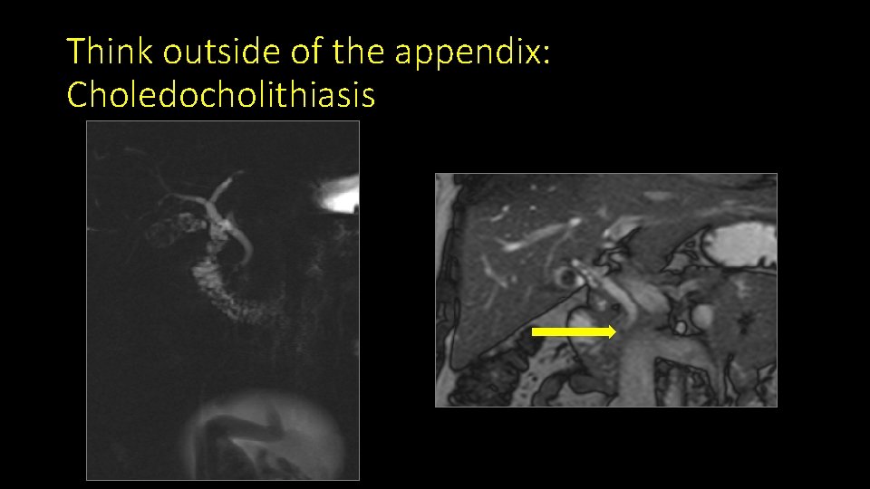 Think outside of the appendix: Choledocholithiasis 