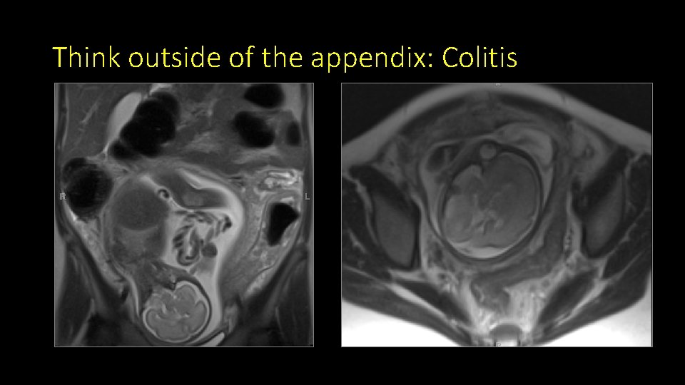 Think outside of the appendix: Colitis 