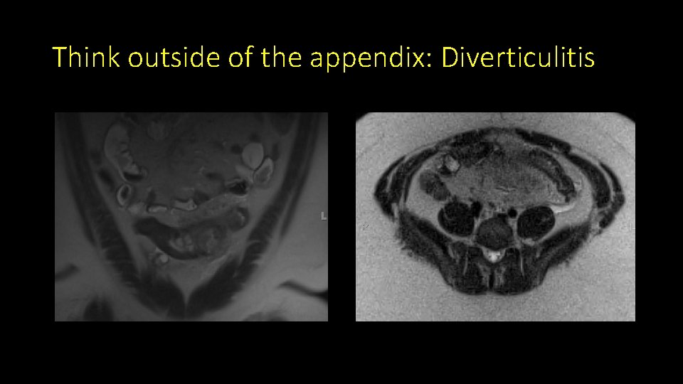 Think outside of the appendix: Diverticulitis 