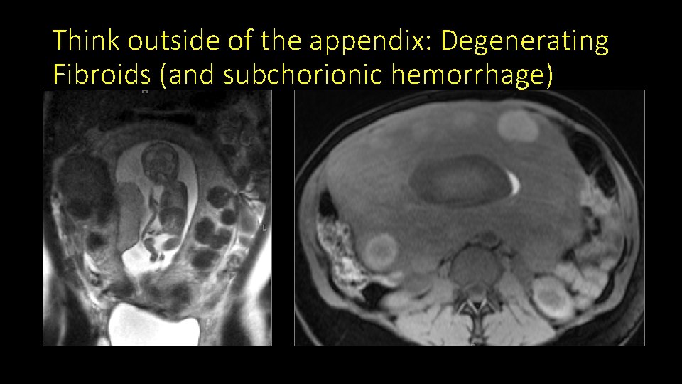 Think outside of the appendix: Degenerating Fibroids (and subchorionic hemorrhage) 