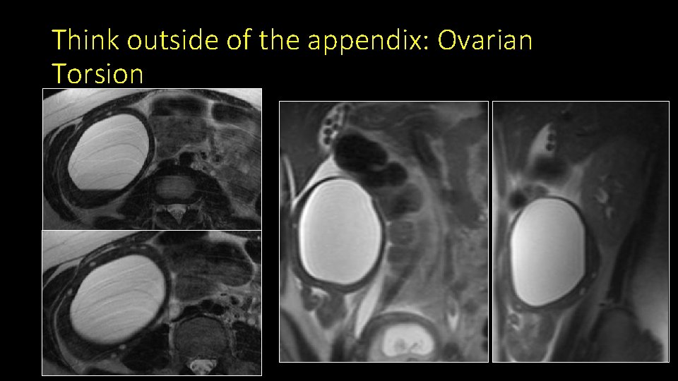 Think outside of the appendix: Ovarian Torsion 