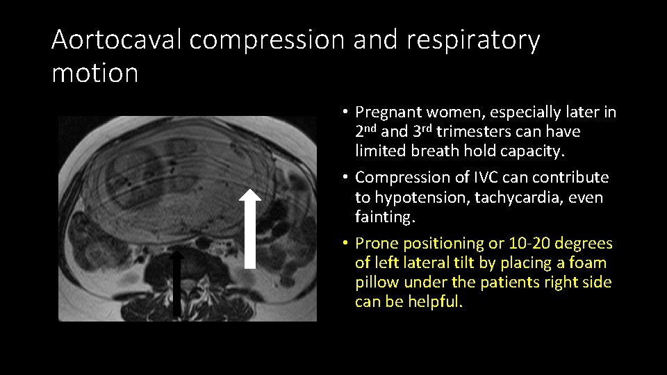 Aortocaval compression and respiratory motion • Pregnant women, especially later in 2 nd and