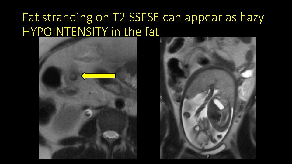 Fat stranding on T 2 SSFSE can appear as hazy HYPOINTENSITY in the fat