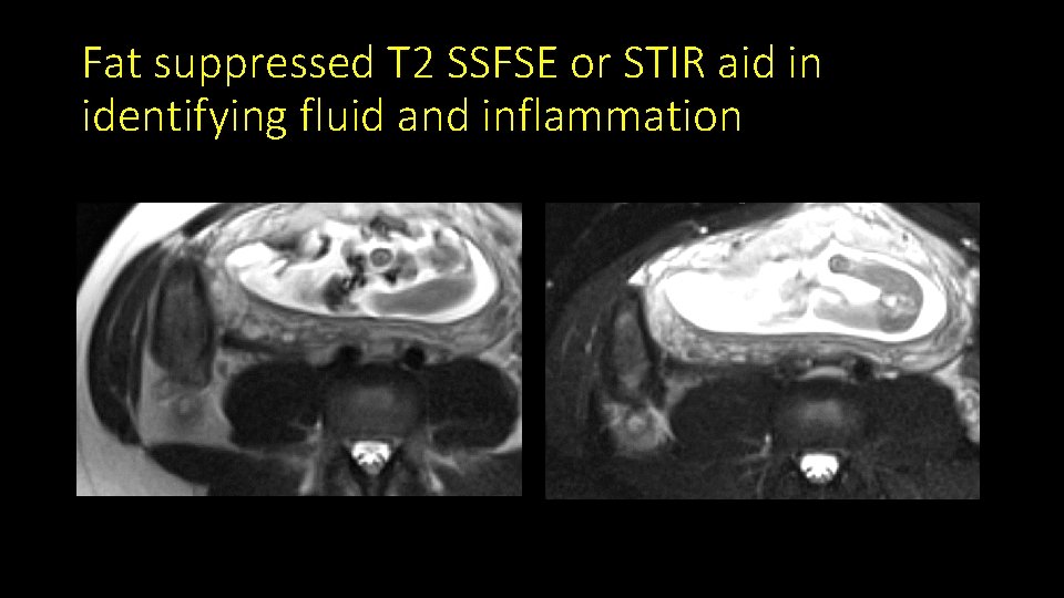 Fat suppressed T 2 SSFSE or STIR aid in identifying fluid and inflammation 