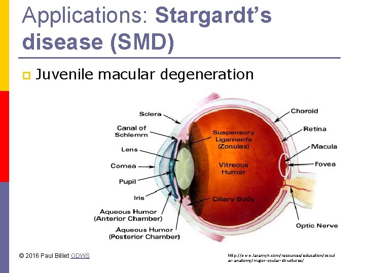 Applications: Stargardt’s disease (SMD) p Juvenile macular degeneration © 2016 Paul Billiet ODWS http: