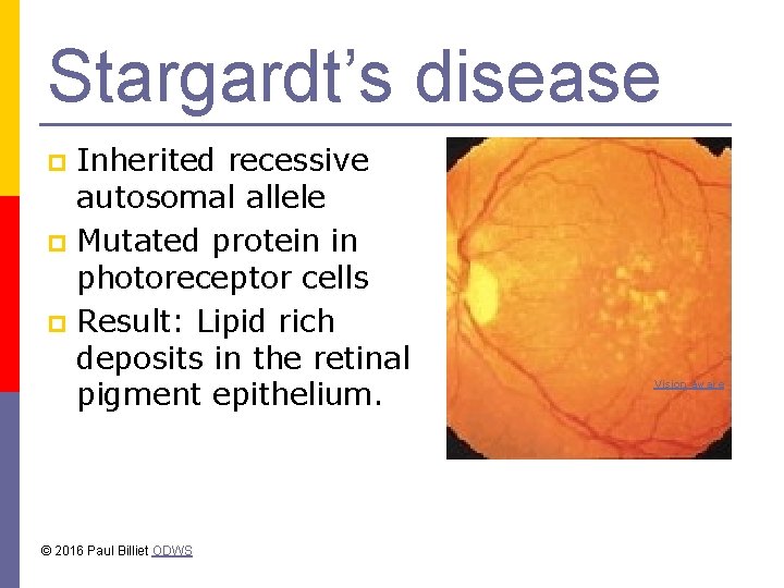 Stargardt’s disease Inherited recessive autosomal allele p Mutated protein in photoreceptor cells p Result: