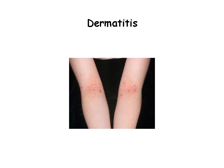 Dermatitis 