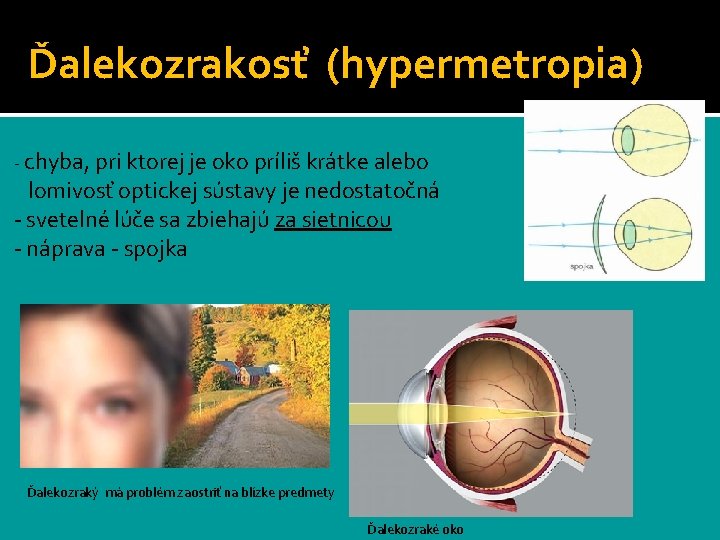 Ďalekozrakosť (hypermetropia) - chyba, pri ktorej je oko príliš krátke alebo lomivosť optickej sústavy